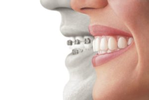 braces vs invisalign